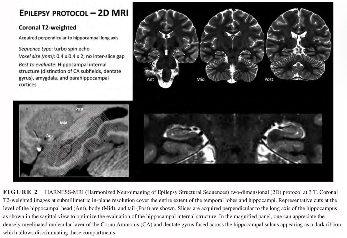 JordiRoldanB's tweet photo. #OnePediNeuroimaging (and adult) 🌏

#neurotools 

In epilepsy, to minimize -MRI when they´re really +MRI, let ´ s adapt our own protocols to the best standar: HARNESS-MRI from the ILAE. 2019

https://t.co/ILP7yMvghi https://t.co/8cXpB3qWYm