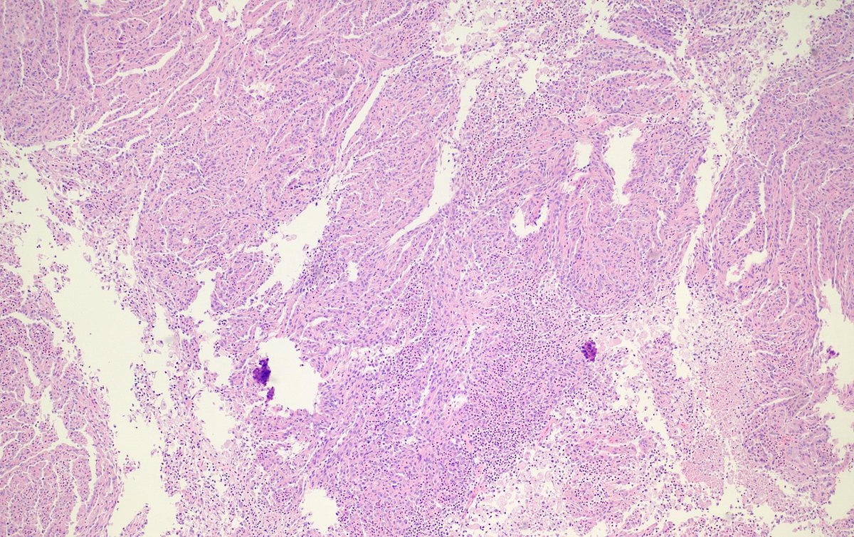 Help from my #gupath friends. Young adult female, papillary-looking kidney tumor. Does the intra-papillary neutrophilic infiltrate signal a specific entity? IHC: CK7+, P504S+, EMA var+, AE1/3 neg