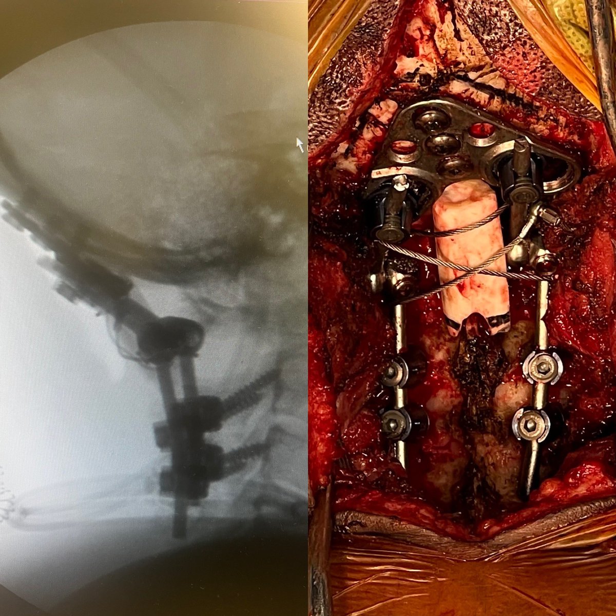 AOD To stabilize you need to fuse the Occiput (skull) to the Cervical Spine. Positioning can be very dangerous and the most challenging part of the surgery to prevent paralysis. Thankfully this patient is doing well. #spinesurgery #traumasurgery #neurosurgery #orthospine