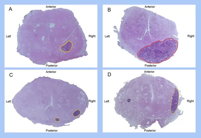 EurUrolOpen's tweet photo. Current Issue: Topography of Prostate Cancer Recurrence: A Single-centre Analysis of Salvage Radical Prostatectomy Specimens and Implications for Focal Salvage Treatments 

https://t.co/k0BObzjMtm 

@GMarra_MD @danieledagate @oderdam @joniau @paolo_gontero 

#prostatecancer https://t.co/l3Xs51qGQa