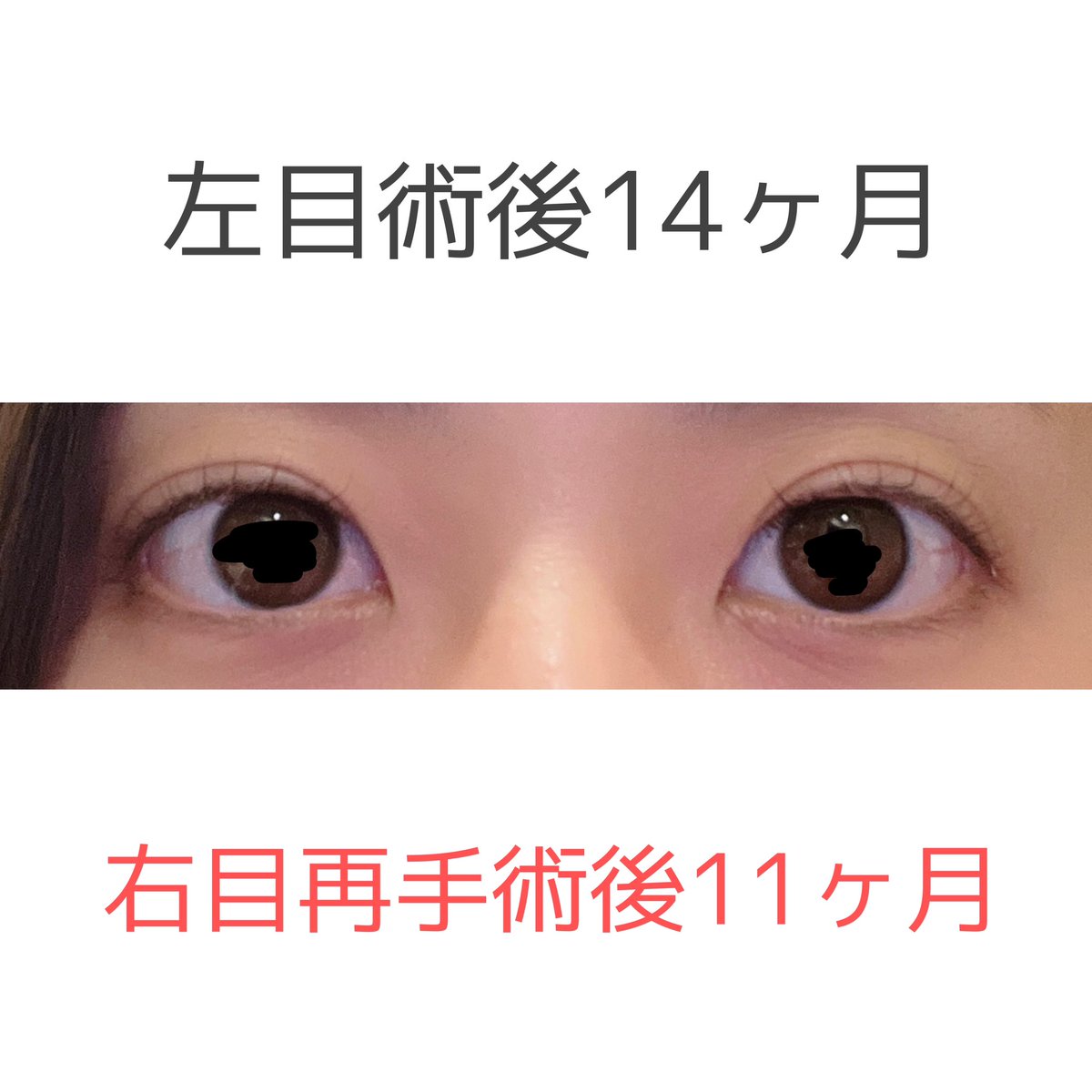 snowsmile412's tweet photo. あげ忘れてたノーメイクでの経過。
私はマツエクよりまつ毛パーマ派です。まじでまつ毛重要。
吉祥寺のサロンにずっとお世話になってるんだけど、持ちはいいしめっちゃ上げてくれるのに3000円台という破格なので本当に助かっている🥹
#眼瞼下垂 #保険適用 #二重切開 #ダウンタイム #DT https://t.co/ds8sGYbvka