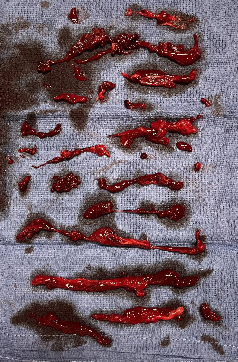 GAC_MDVasc's tweet photo. Single session percutaneous mechanical thrombectomy case using the new @penumbrainc Lightning Flash for acute lower extremity DVT with excellent result! Using the latest tech at the University of Louisville Vascular Surgery Division! @KMoreland15 @Chaz_malone https://t.co/qkAr3xmjdL