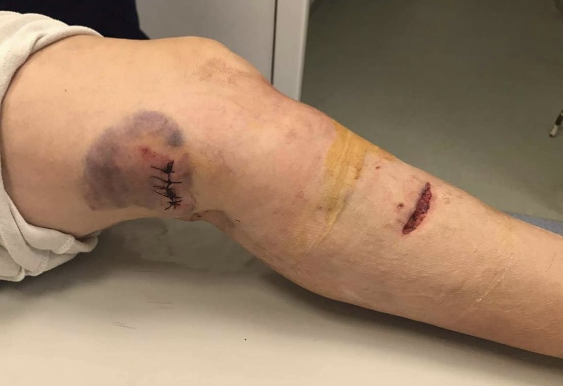 Знам дека изгледа МНОГУ ЛОШО ама ова се слики објавени како повреди од кучињата на жената од Струга. “Кученцата не направиле ништо лошо никому, само бараат љубов и дом” ?
Па да ми е некој од семејство ова не со пушка, со заби ќе ги удавам.
