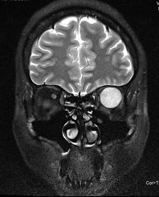 brown-hospital-medicine-on-twitter-a-45-year-old-female-presented