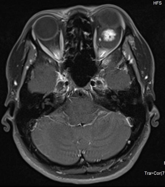 brown-hospital-medicine-on-twitter-a-45-year-old-female-presented