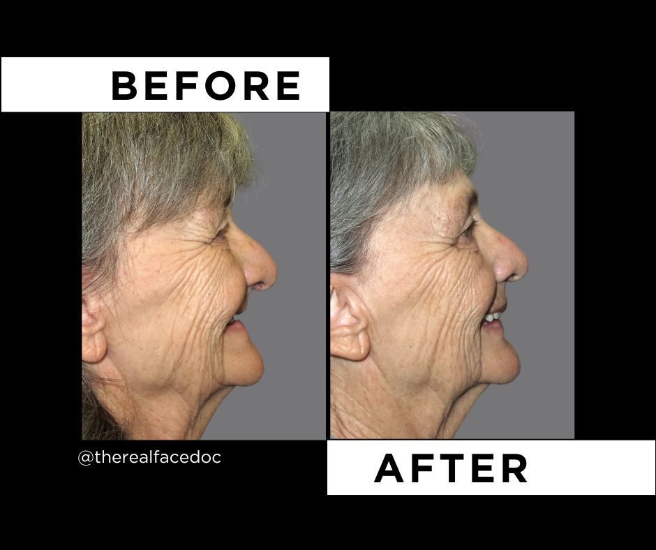 therealfacedoc's tweet photo. For our patients whose facial structure has changed since the deterioration of their natural teeth (like having many missing or no teeth), New Teeth Now prosthetic teeth can restore their facial shape and volume. You can see with Edith here how much more facial volume she has ... https://t.co/oOIC63SSpH