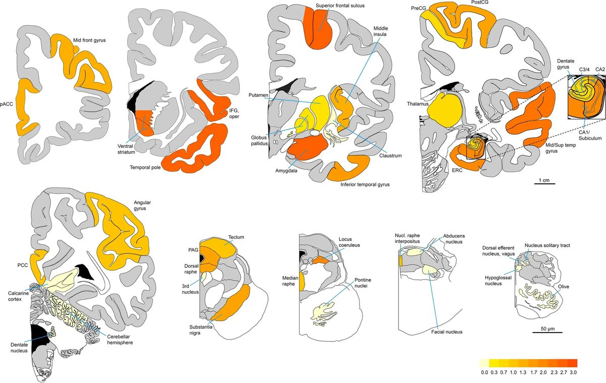 Tuberous sclerosis complex is associated with a novel human tauopathy. Observed in the absence of pathological amyloid beta, TDP-43, or alpha-synuclein deposition. bit.ly/3ZswB4l
<a href="/itsmecamib/">Camila Benitez</a> <a href="/carolalquezar/">Carolina Alquezar</a> @BruceMiller <a href="/AimeeKaoLab/">Kao Lab</a> #NIAfundedADRC <a href="/BluefieldProj/">Bluefield Project</a> @RCFNe…