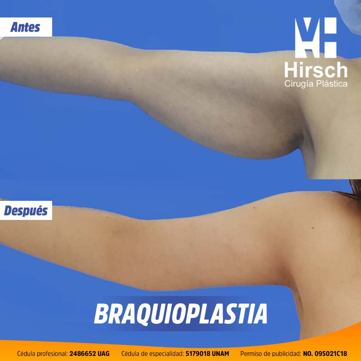 PlastikMike's tweet photo. ¡Empieza el 2023 eliminando la flacidez de tus brazos con esta cirugía! 💪😊
Si quieres saber más: https://t.co/Rl7bi6N4AJ
💻
Mi facebok 📲https://t.co/nLfLk1ndSy
#doctor #hirsch #certificado #cirugia #plastica #reconstructiva #cita #valoracion https://t.co/KpcSaPDwOv