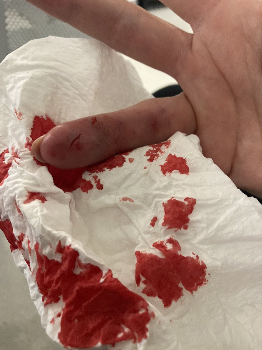 So last night our Rottweiler, Noodles did this to <a href="/SOwen1969/">Sarah Lou</a>

Seriously, the most laid back dog you will ever see, she was half asleep and protecting her treat stick and Sarah moved suddenly. 

She spent the night in the doghouse, but’ been forgiven. Little bugger.