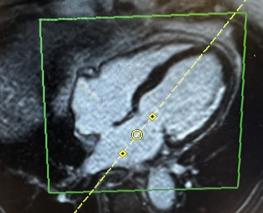 The PULSE-MI trial (@pulsemi_trial) on Twitter photo Does prehospital administration of pulse-dose methylprednisone reduce final infarct size in #STEMIpatients? The #RCT have been running for almost 2 months and we have included 155 patients. Now, the first patients are being called in for the 3-months follow-up #CMR🫀<a href="/RigsHeart/">RigsHeart 🫀🚨</a> Does prehospital administration of pulse-dose methylprednisone reduce final infarct size in #STEMIpatients? The #RCT have been running for almost 2 months and we have included 155 patients. Now, the first patients are being called in for the 3-months follow-up #CMR🫀<a href="/RigsHeart/">RigsHeart 🫀🚨</a>