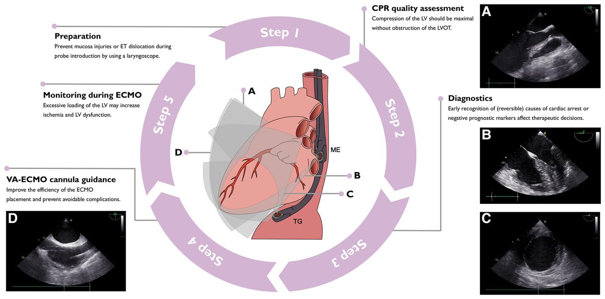 How to perform focused #TEE during extracorporeal CPR? 

⚙️ Overview of the five-step protocol and schematic representation of the four important #TEE views during the protocol.

#EHJCVI @ESC_Journals #EMCCM #ResusTEE #ECPR #FOAMcc #FOAMed #PoCUS #FOAMus 

academic.oup.com/ehjcimaging/ad…