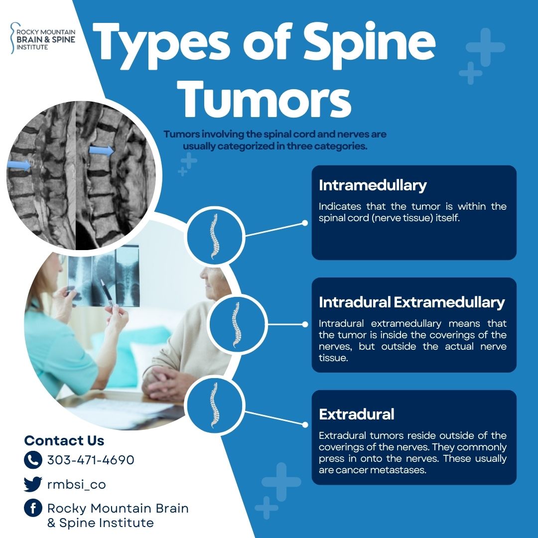 rmbsi_co's tweet photo. Spine tumors can be a complex topic, so it's important to know the different types. Click here for more information about spine tumors ➡️ https://t.co/92Ab75honq https://t.co/p2vPyGfJCO
