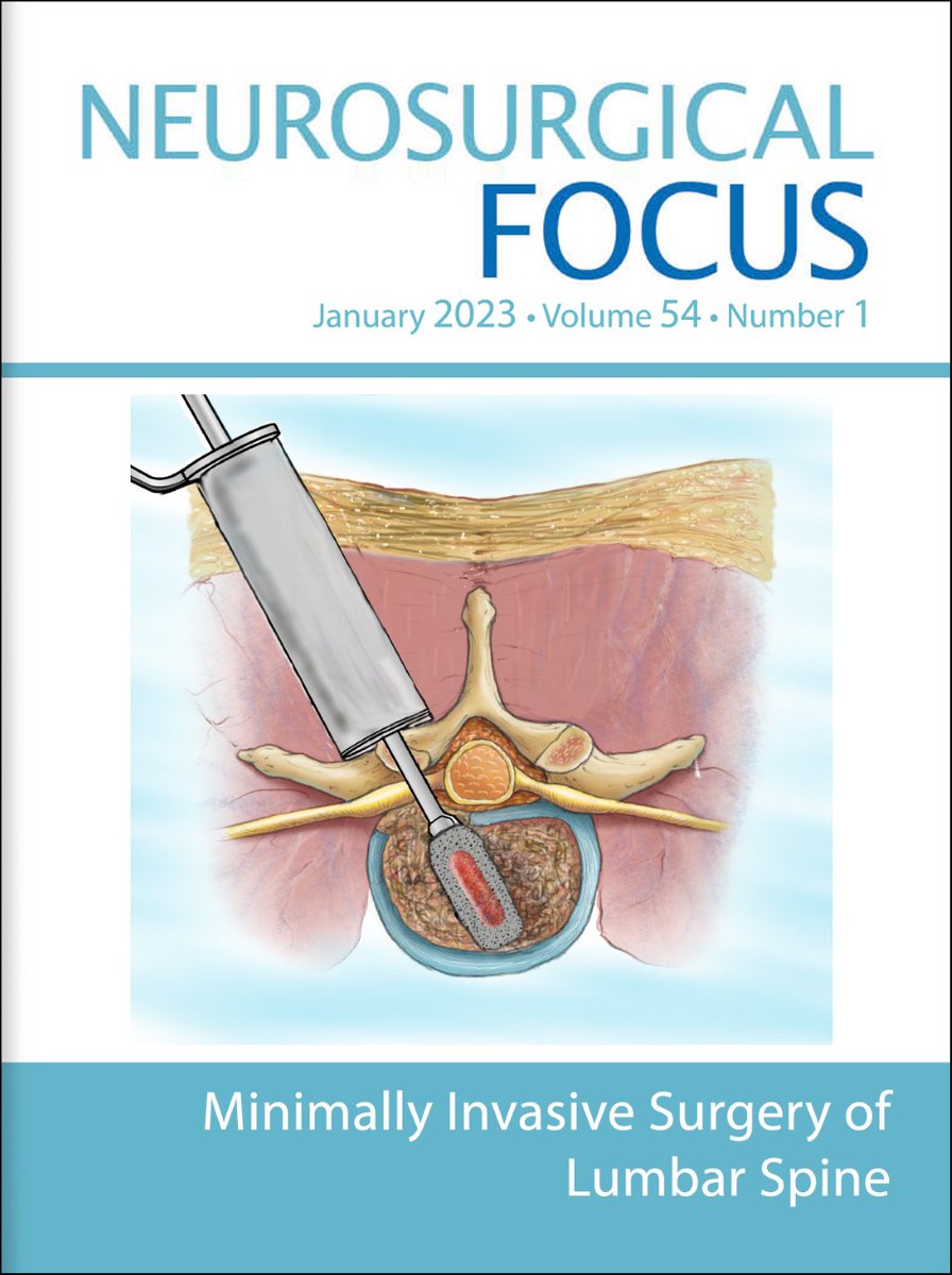 On the January cover of Neurosurgical Focus, <a href="/andrewchanMD/">Andrew Chan, MD</a>, Praveen Mummaneni, MD, &amp; colleagues show no difference in 5-year outcomes between minimally invasive and open transforaminal lumbar interbody fusion in patients with lumbar spondylolisthesis: thejns.org/focus/view/jou…