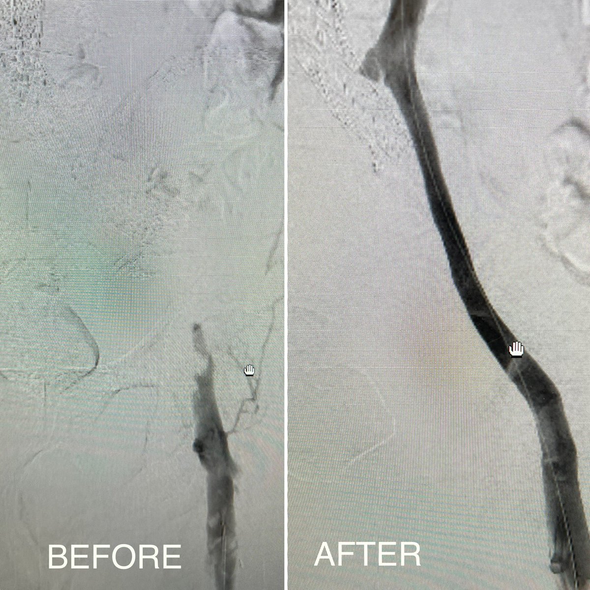 Abdullah Al Rifai MD FACC FSCAI RPVI (@abd_alrifai) on Twitter photo Lucky to be 1st in Chicago and Midwest to try Penumbra #LightningFlash Thrombectomy system! Symptomatic Extensive Ilio-Fem DVT cleaned in 10 mins and home same day! Truly game changer device. <a href="/PenVascular/">Penumbra Vascular</a> <a href="/theclotgirl/">Nathalie Kauffman</a> <a href="/JaafGolzar/">Jaafer Golzar MD FACC, FSCAI</a> Lucky to be 1st in Chicago and Midwest to try Penumbra #LightningFlash Thrombectomy system! Symptomatic Extensive Ilio-Fem DVT cleaned in 10 mins and home same day! Truly game changer device. <a href="/PenVascular/">Penumbra Vascular</a> <a href="/theclotgirl/">Nathalie Kauffman</a> <a href="/JaafGolzar/">Jaafer Golzar MD FACC, FSCAI</a>