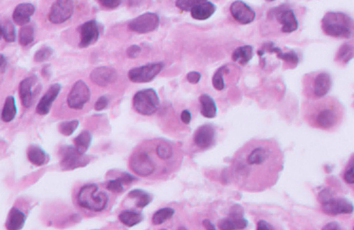 11 yo girl with a parietal bone lesion No stains yet, but there is one most likely diagnosis What is it and what is the most common molecular alteration? #PathTwitter #PediPath @GeronimoJrLapac @JCandidoXavier @RawiaMo57385655