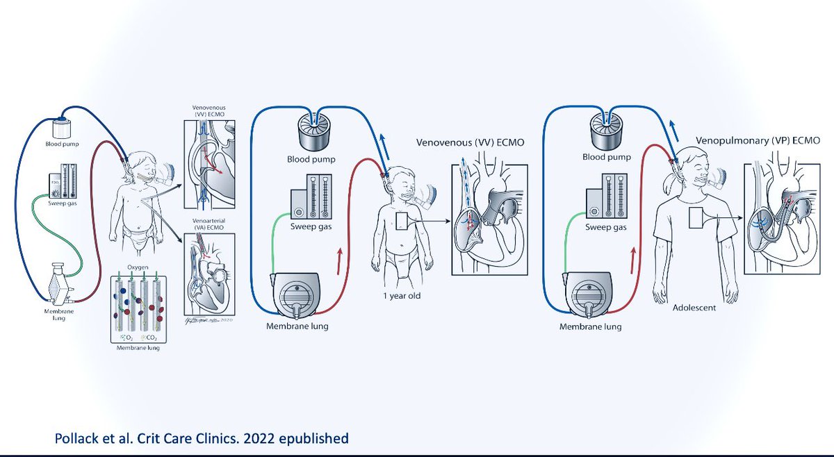 StaceSears's tweet photo. Shout out to @blythe_pollack - congrats on your latest publication 😍😍 #ecmo #candacy so proud of you 👏 https://t.co/dhjpkOneC8