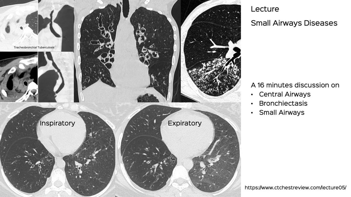 bhavinj's tweet photo. Lecture: Airways Diseases
https://t.co/spR5AqSANl
A short lecture on central airways, bronchiectasis and small airways
#chestrad #ctchest #FOAMrad #radres #bronchiectasis #centralairways #smallairways https://t.co/sHzbtoBfGr