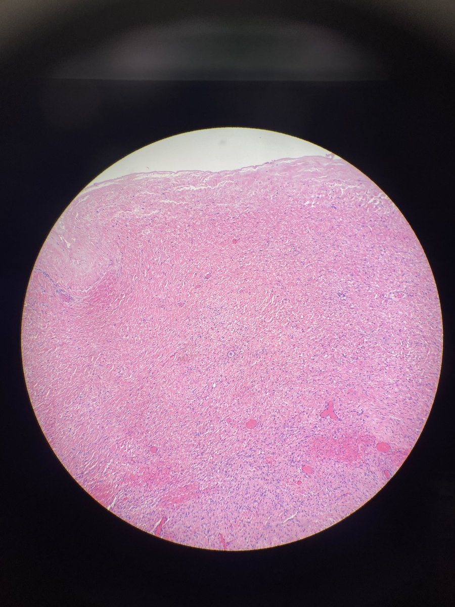 Mucinous Ca in the Ov of an 18 yo Pt. Primary in the Ov bc the Ov cortex is abnormal. No cellular cortex and very few oocytes. Human Path 2021, 108:32. Nice to confirm previous observations not accepted by some reviewers.We need to listen to the tissue. ⁦<a href="/IGCSociety/">IGCS</a>⁩