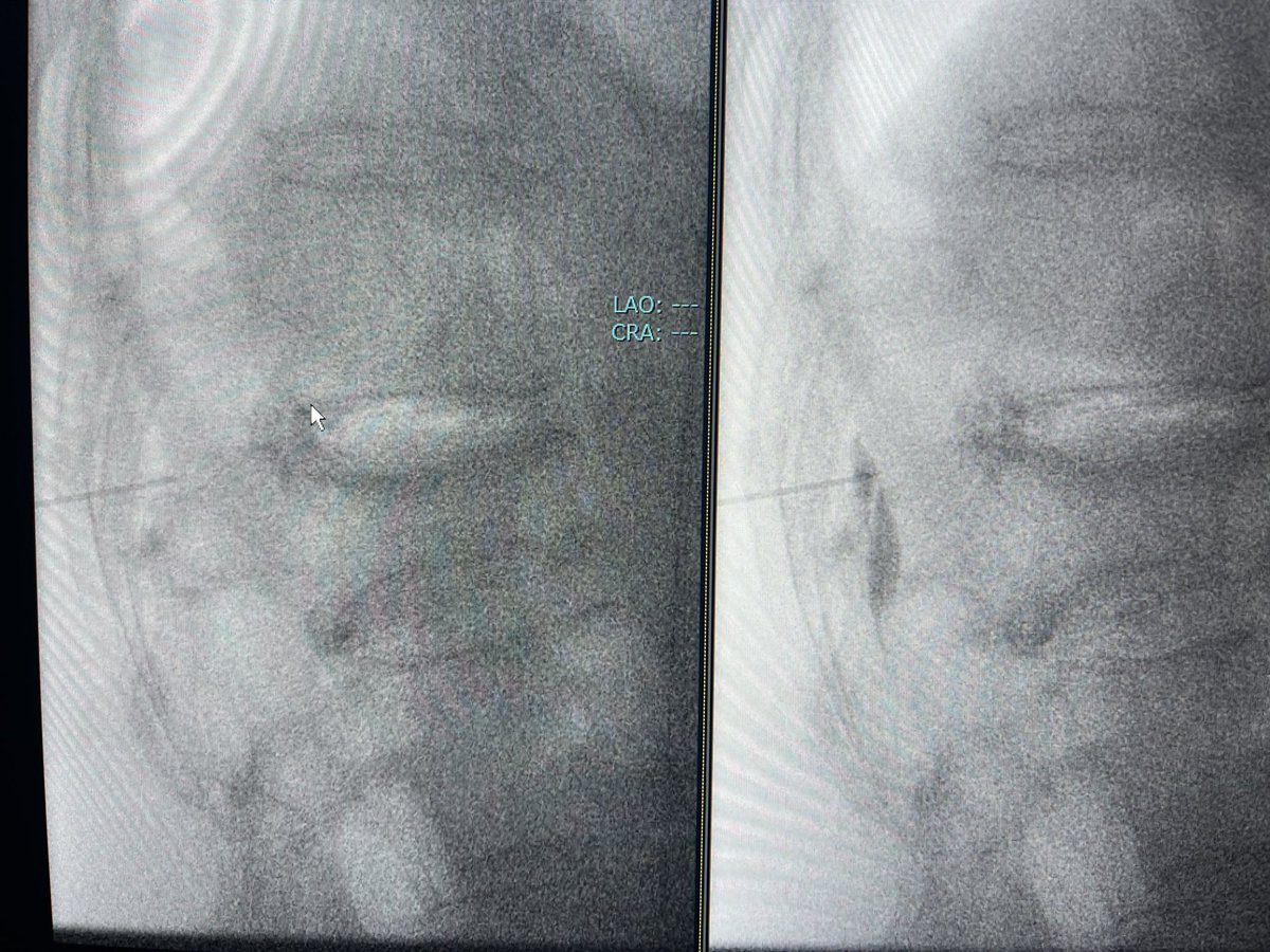 darthglader's tweet photo. First, #EpiduralBlock for intra-operative pain. Fractures are at T11 and L1, so block at T12-L1. Block with lido, ropivacaine, and kenolog. https://t.co/Ep58fOz8bV