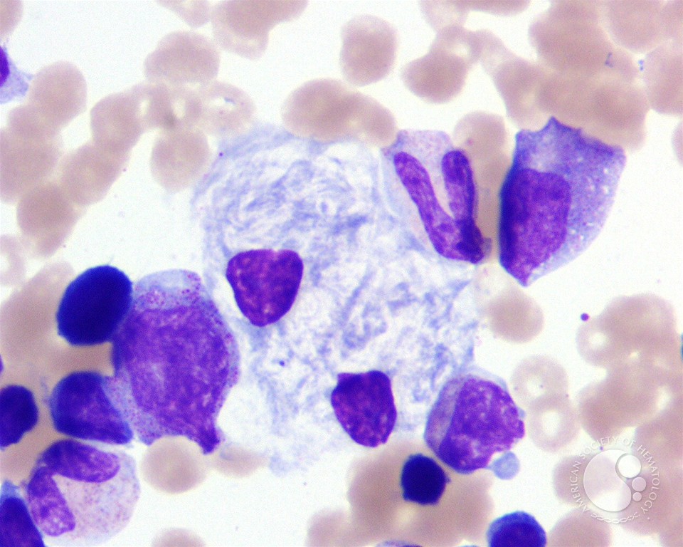 nihardesai7's tweet photo. Hey #MedTwitter !!

🤧

Identify the abnormal cells?
Diagnosis?
Treatment?

#MedEd https://t.co/7ymMR4Qwke