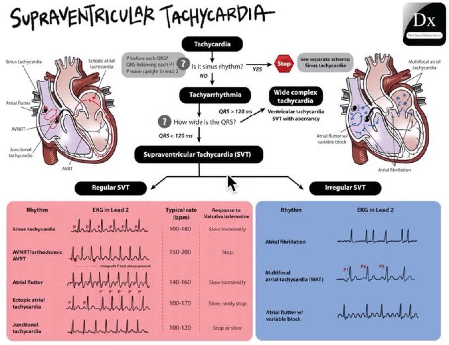 The Innovation | Medicine (@innov_medicine) on Twitter photo Approach to Supraventricular tachycardia (SVT) 
<a href="/CPSolvers/">The Clinical Problem Solvers</a> #MedEd #FOAMed Approach to Supraventricular tachycardia (SVT) 
<a href="/CPSolvers/">The Clinical Problem Solvers</a> #MedEd #FOAMed