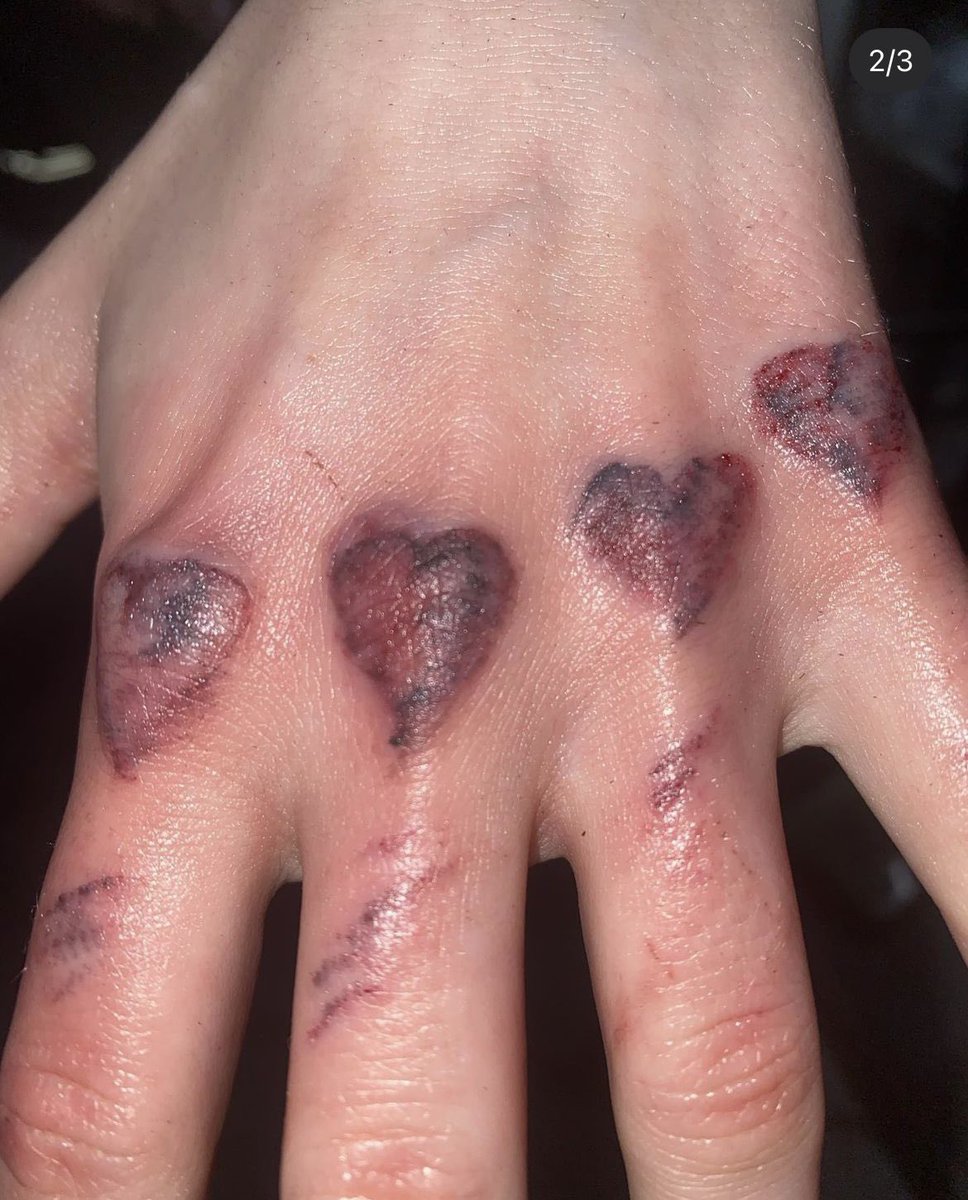ic3kpeak's tweet photo. queria tanto achar algum tatuador FODA aq em sp que faça tatuagem de hematoma juro q to OBCECADA https://t.co/RduGguHwna