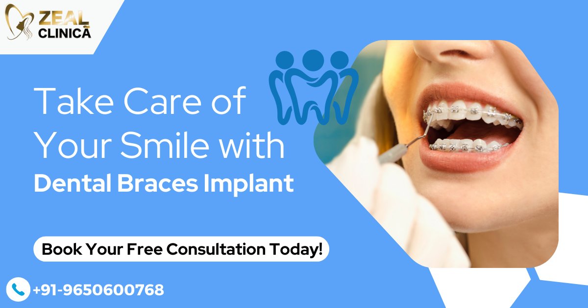 ZealClinica's tweet photo. Going for #braces in the first place is advisable if you want both dental ๐ฆท implants and orthodontics. At #ZealClinica, one of the most trustable dental offices ๐ข in the town.
#braceslife #bracesjourney #bracesproblems #dentalimplant #dentalimplants #implants #implantsurgery https://t.co/Cm7PlfRTqH