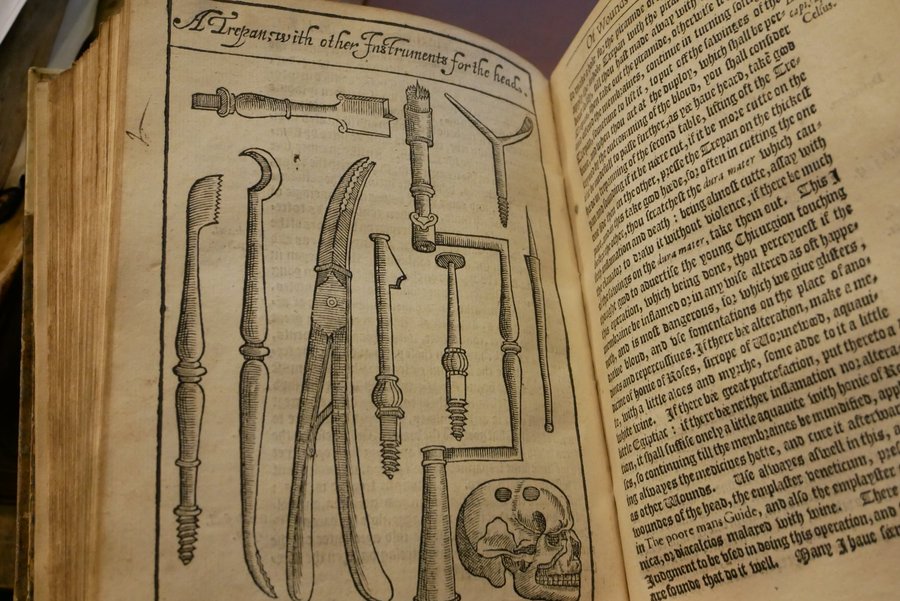 Medicine's Bizarre History on Twitter: "RT @RCPEHeritage: 16thc trepan