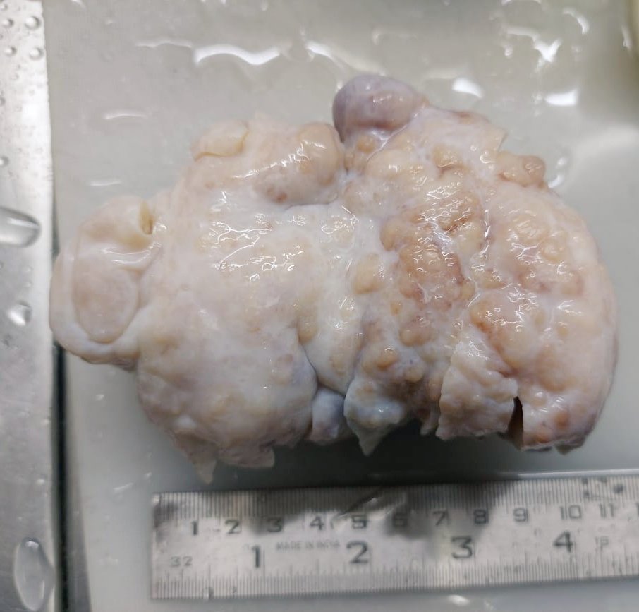 megha_lalcheta's tweet photo. 70/F, Adnexal mass - adherant to ovary
#FGTpath #Pathology #Pathtwitter #pathresidents https://t.co/uK6MqIUIS1