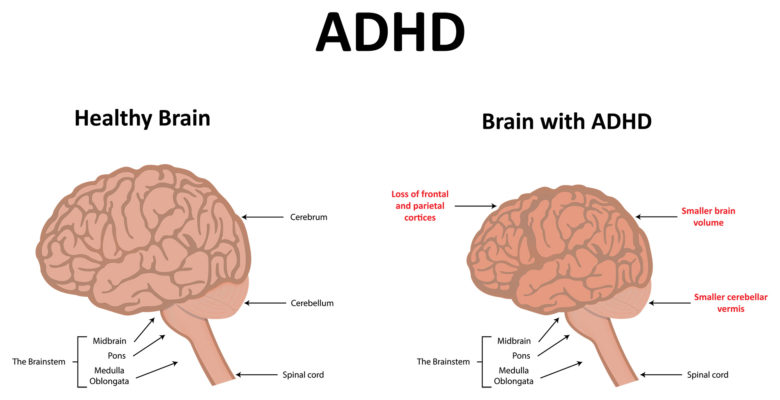 jclinicalmedres's tweet image. Attention deficit/hyperactivity disorder is a mental health condition exhibited by difficulty maintaining attention. ADHD is a mental health condition that can lead to unstable relationships, poor work performance, and low self-esteem.
#Attentiondeficithyperactivitydisorder