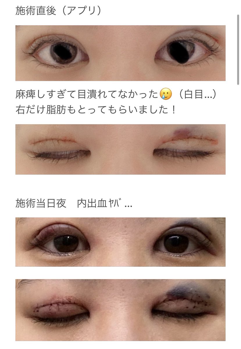 krkrmmm15's tweet photo. 二重切開してきました✌️

埋没目
DT0日（当日）〜3日目

#二重整形 #二重全切開 #二重切開 #二重埋没 https://t.co/kPk4K7fHRm