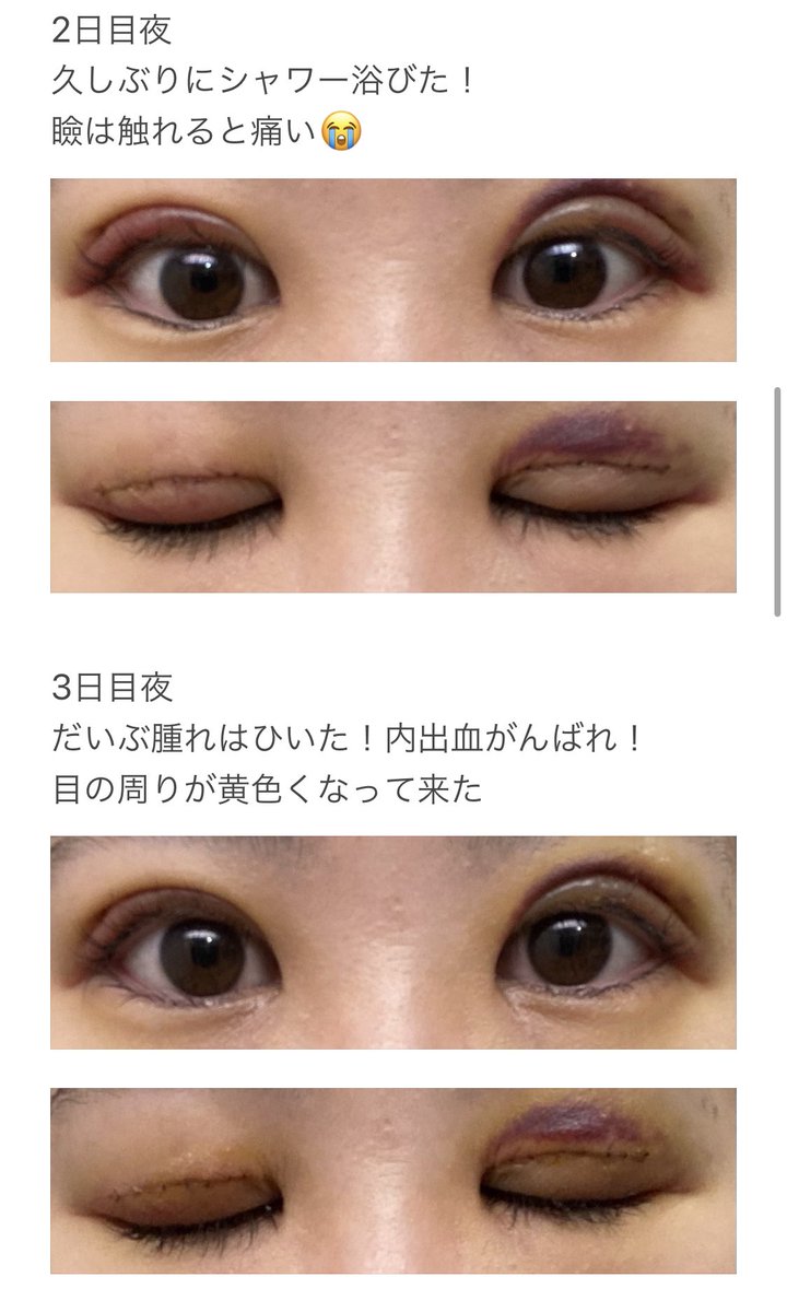 krkrmmm15's tweet photo. 二重切開してきました✌️

埋没目
DT0日（当日）〜3日目

#二重整形 #二重全切開 #二重切開 #二重埋没 https://t.co/kPk4K7fHRm