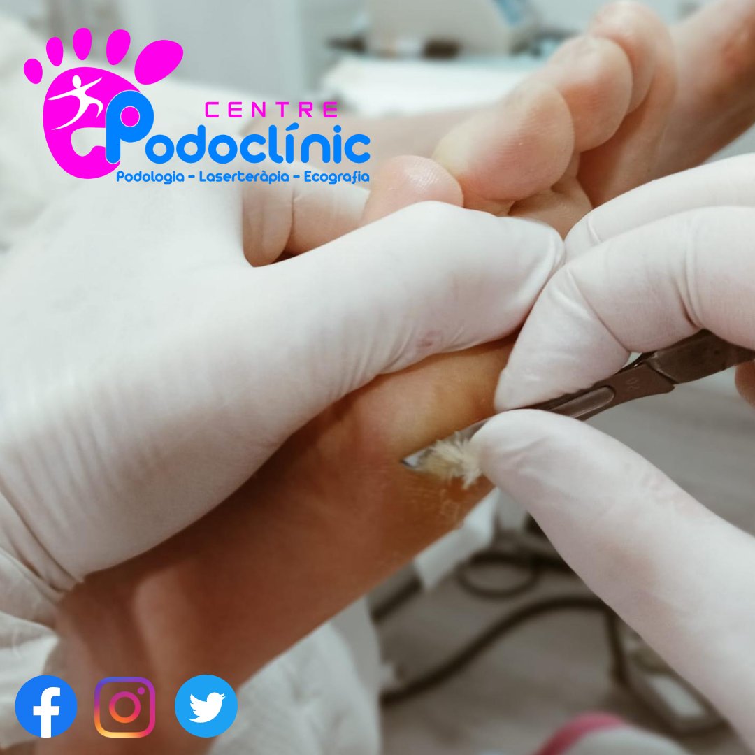 🦶🏻Les durícies plantars apareixen per un excés de fricció o pressió en zones del peu.😵
La quiropòdia elimina les durícies per a prevenir futures molèsties.🤗
📍 Centre Podoclínic, al carrer València núm. 9 baix de Tavernes de la Valldigna.
📞 96 282 25 62.
📲 605 26 97 97