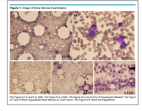 IMOJ5's tweet photo. Successful Third Hematopoietic Stem Cell Transplantation for...by Hitoshi Hanamoto MD [ISSN 2572-9233]

Read the full article here: https://t.co/XlfsuL6hMx

For manuscript submission click here: https://t.co/kANinO30jX

#openventio #internalmedicine #leukemia #OpenAccess https://t.co/Ha2xvyqExJ