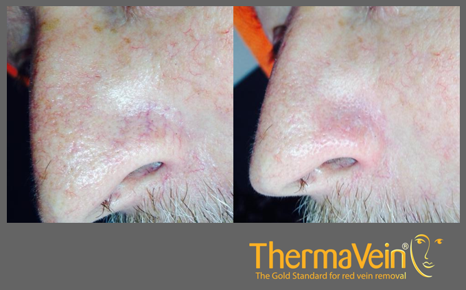 thermavein's tweet photo. ThermaVein is both a time and clinically proven safe and cost effective alternative to laser, IPL and electrolysis.
It is the safe, instant and effective treatment for red veins and more.
#veins #redveins #threadveins #aesthetics #beauty #IPL #laser #electrolysis https://t.co/v5EgA2Zpn8