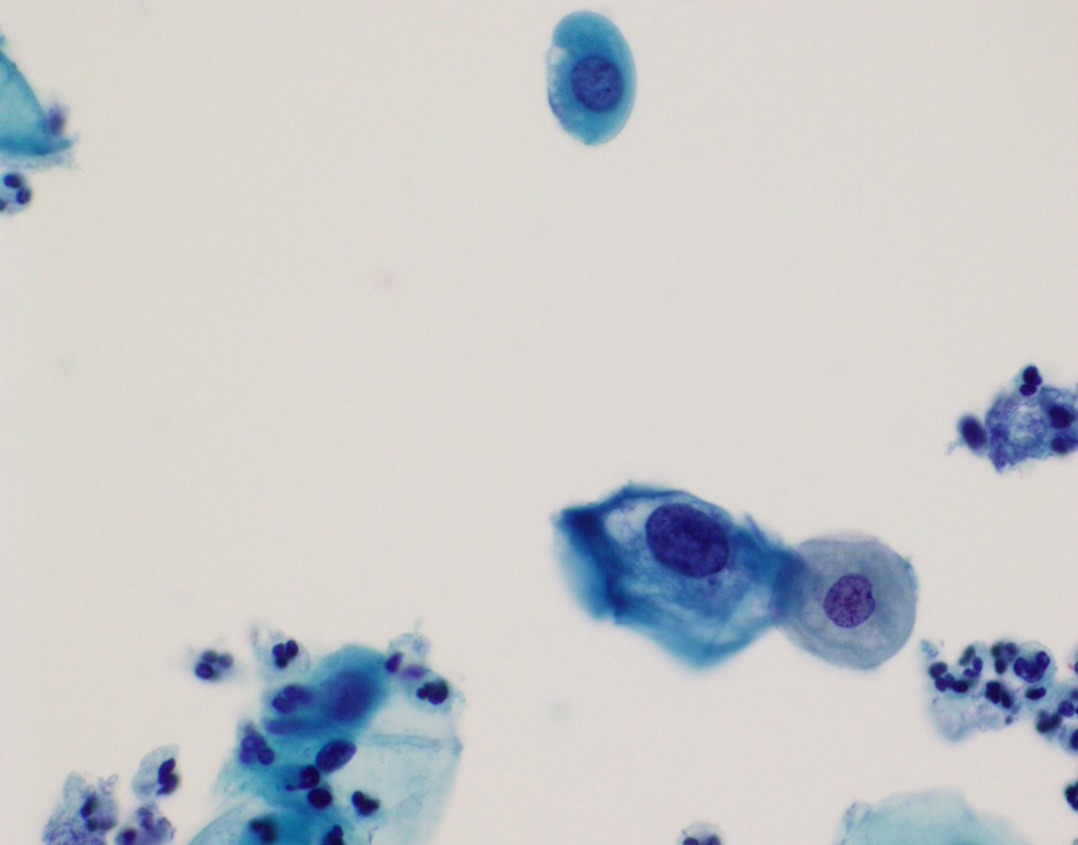 40 year old female with a negative pap history. What is your diagnosis on this cervical pap smear? #PathTwitter #cytopath #cytopathology #cytology