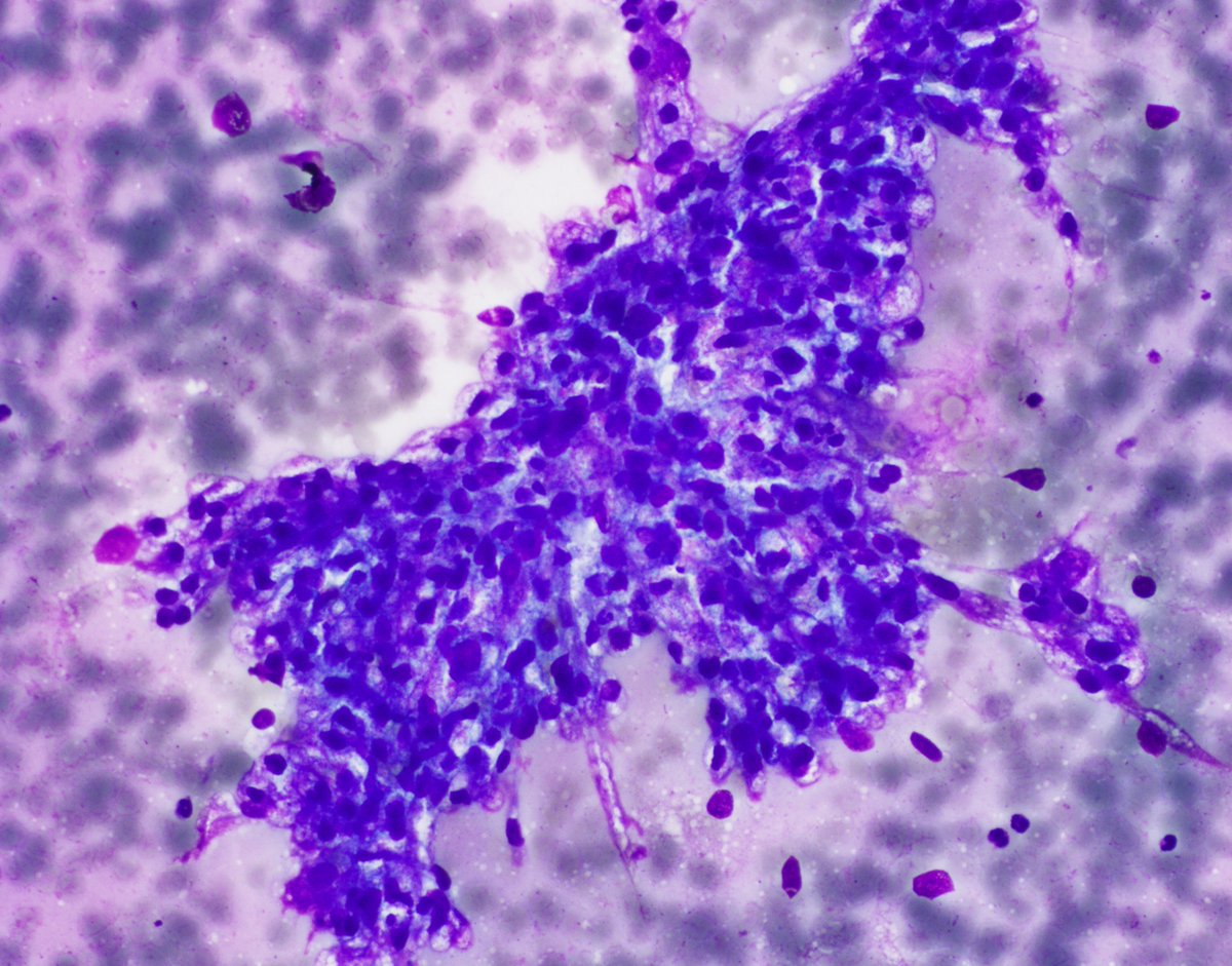 UpstateCytology's tweet photo. 62 year old male with hilar lymphadenopathy and flank pain. Pictured are images from an #FNA of hilar lymph node. What is your diagnosis? #PathTwitter #cytopath #cytopathology #cytology https://t.co/wuCEl6AkYM