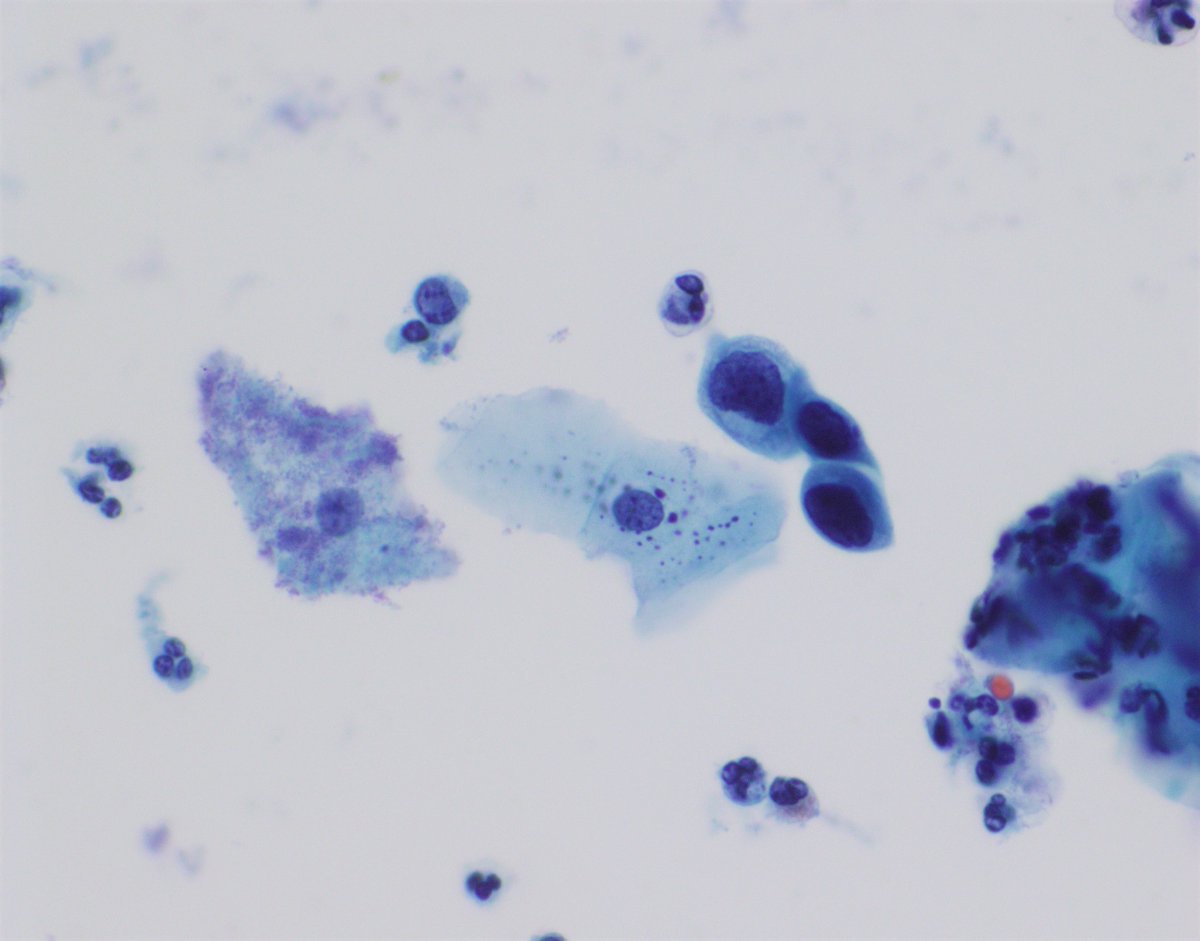UpstateCytology's tweet photo. 33 year old female with a past history of LSIL. What is your diagnosis for this cervical pap smear? #PathTwitter #cytopath #cytopathology #cytology https://t.co/qi3jJ6Alxm