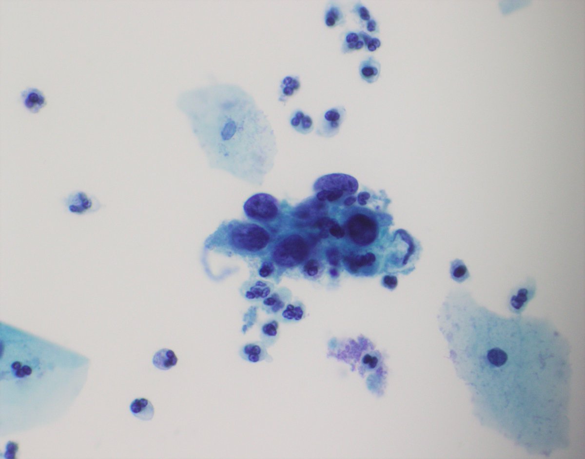 33 year old female with a past history of LSIL. What is your diagnosis for this cervical pap smear? #PathTwitter #cytopath #cytopathology #cytology