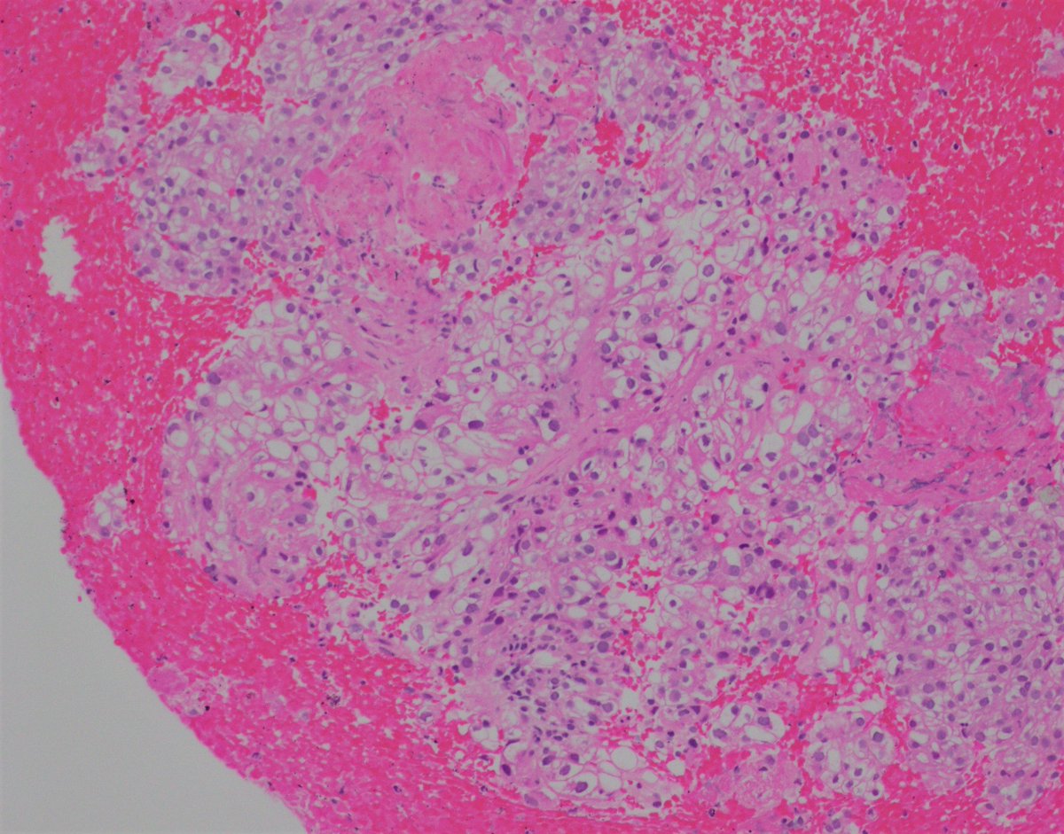 UpstateCytology's tweet photo. 62 year old male with hilar lymphadenopathy and flank pain. Pictured are images from an #FNA of hilar lymph node. What is your diagnosis? #PathTwitter #cytopath #cytopathology #cytology https://t.co/wuCEl6AkYM