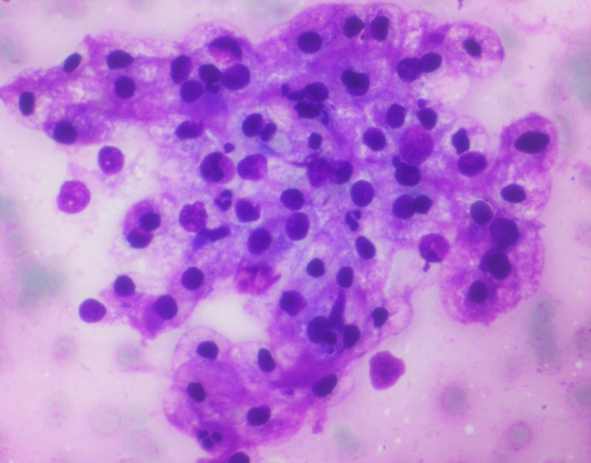 62 year old male with hilar lymphadenopathy and flank pain. Pictured are images from an #FNA of hilar lymph node. What is your diagnosis? #PathTwitter #cytopath #cytopathology #cytology