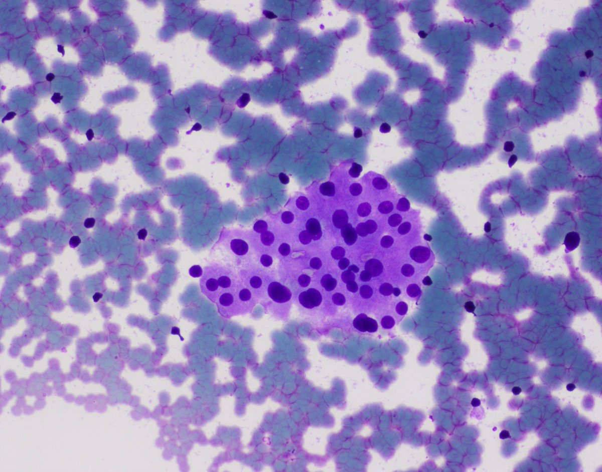 UpstateCytology's tweet photo. 57 year old female with a high serum TSH and low serum free T4. This is an #FNA of the thyroid. What is your diagnosis? #PathTwitter #cytopath #cytopathology #cytology https://t.co/IxG3I5whAd