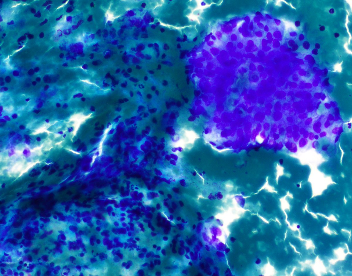 57 year old female with a high serum TSH and low serum free T4. This is an #FNA of the thyroid. What is your diagnosis? #PathTwitter #cytopath #cytopathology #cytology