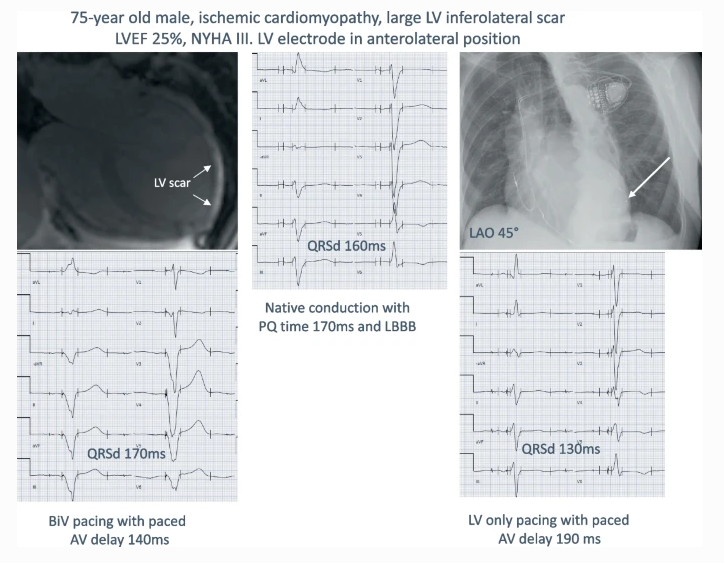JICE_EP's tweet image. 🚨Latest #OpenAccess Article in 
@JICE_EP

Maximizing QRS duration Reduction in Contemporary CRT is feasible &amp;amp; Shorter QRS Duration is Associated with Better Clinical Outcomes

by @RBorgquist @PlatonovPyotr &amp;amp; @david_mortsell 

☕️📖 #OpenAccess: doi.org/10.1007/s10840…

#EPeeps