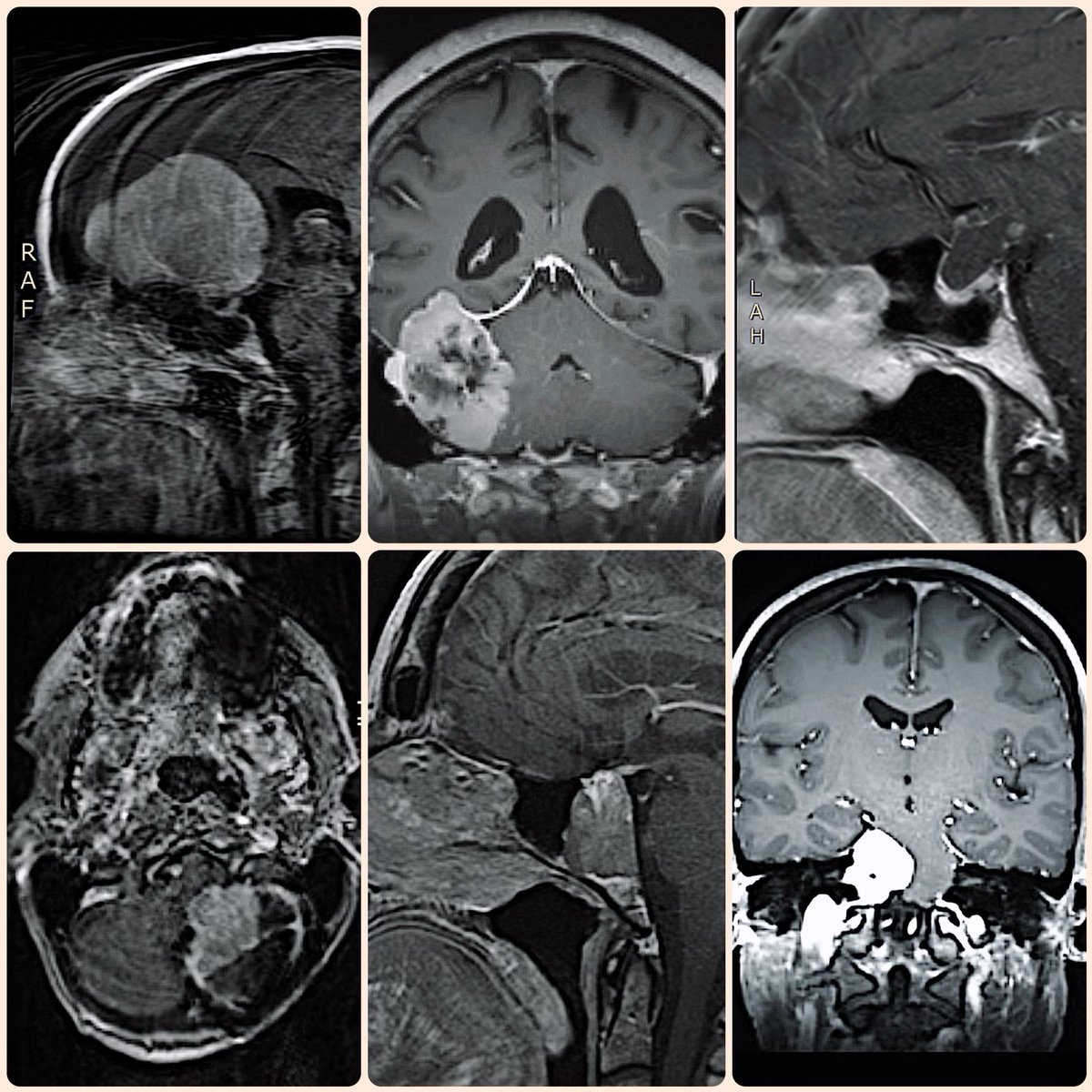 BorgheiRazaviMD's tweet photo. First week of 2023 started with big tumors 💀 🧠 @CleveClinicFL @DrBadihAdada @yournosedoctor https://t.co/rRxLBo5btE