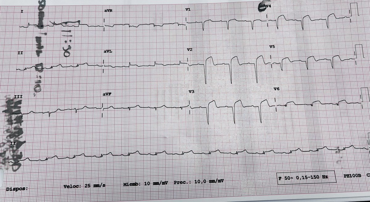 Male 👨🏻‍🦱72 yo, HTN, Diabetes IR, 24 hour with chest pain, Which is the culprit vessel?? guess the segment 🫀🏃🏻‍♀️ #CardioTwitter #Radialfirst #WIC 
@ramicule @torresviera @mirvatalasnag @carlaagatiello1
