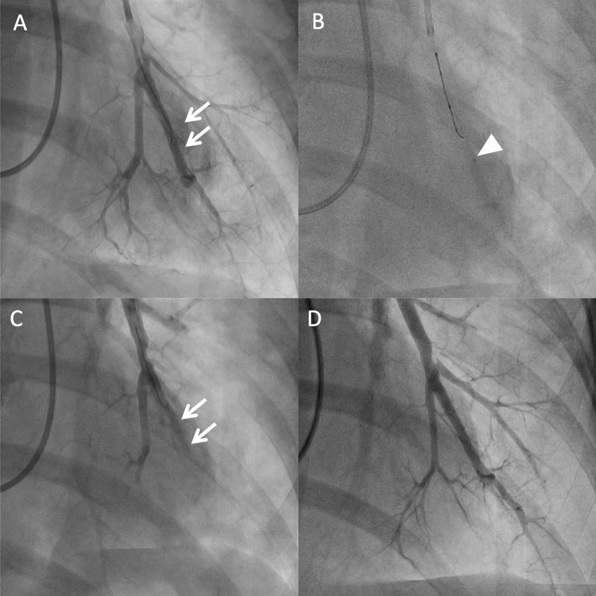 Gelatin sponge embolization is promising to minimize vascular injury during angioplasty for #CTEPH

Representative case figure: A, vascular injury; B, embolization; C, after embolization; and D, after 3 month.
Find full contents bit.ly/3ZnA3xc @JACCJournals #JACCAsia