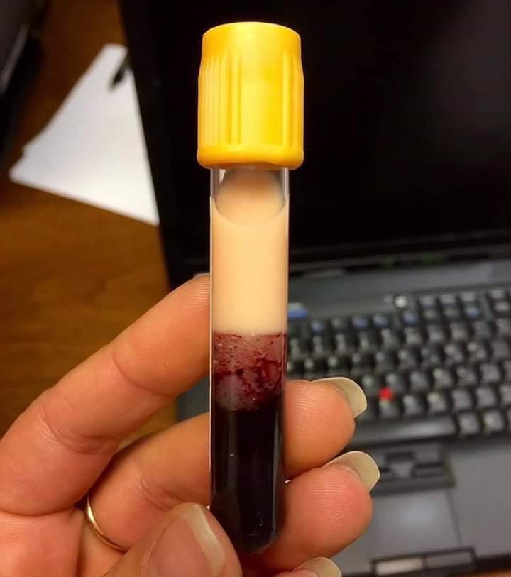 drkeithsiau's tweet photo. Bloods taken from a young patient with alcohol excess and acute pancreatitis. What’s the diagnosis? https://t.co/LYuy5JFxcl