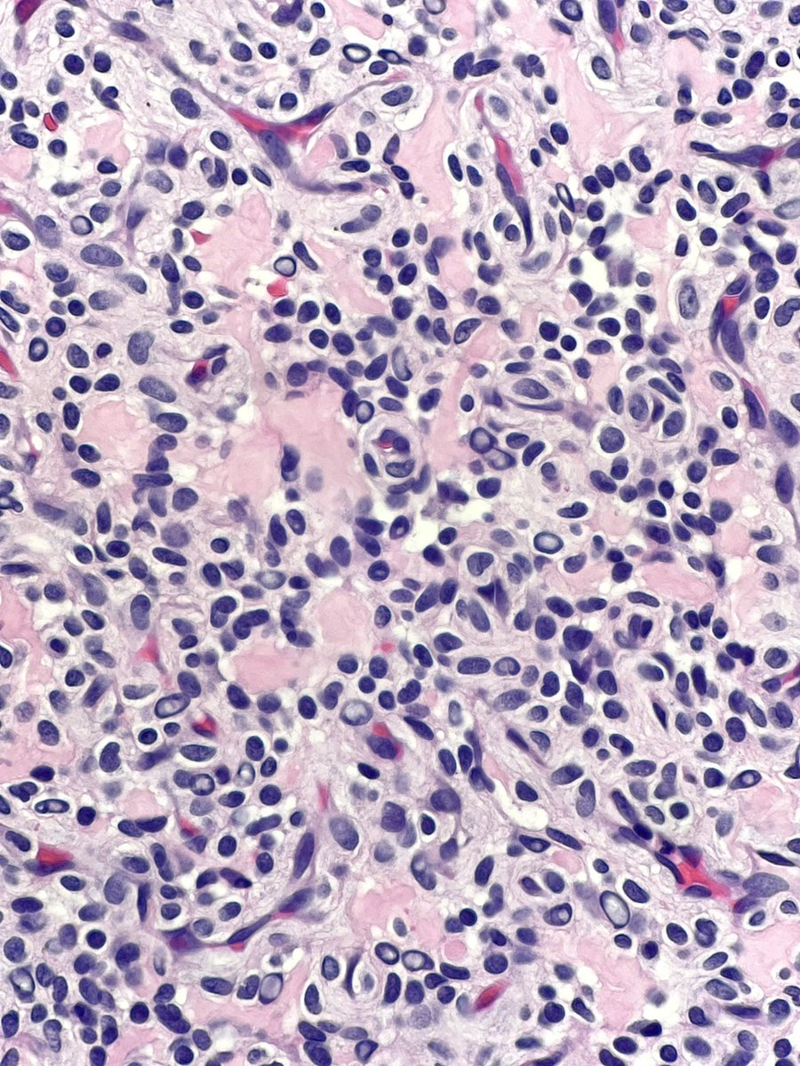 Patient presents with a red-blue, painful subungual nodule on the index finger. Diagnosis? What gene rearrangement is commonly involved? Answer and pearls in the comments! #PathTwitter #MedEd #BSTpath