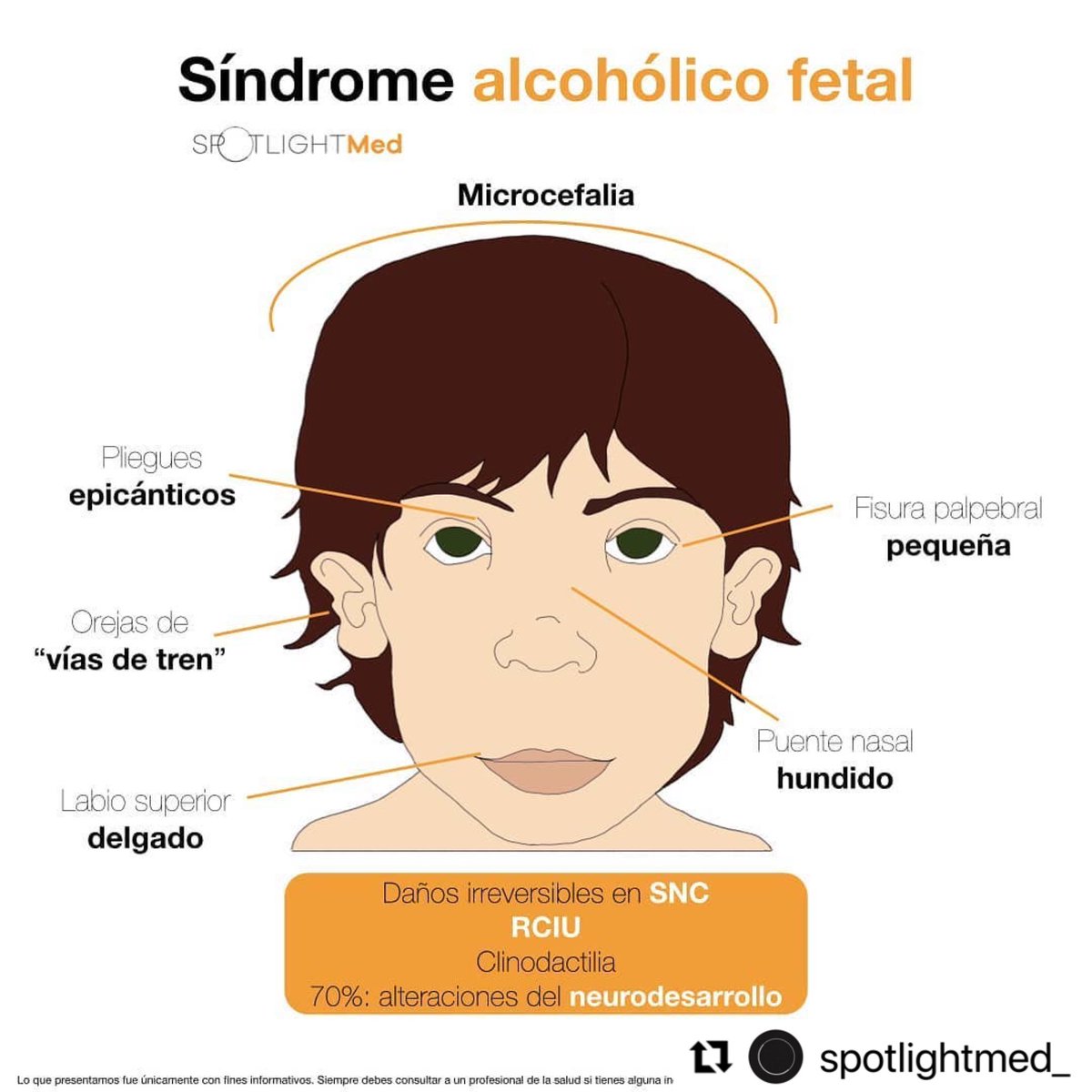 Síndrome alcohólico fetal 🤰🏻🍸 #spotlightmed #ENARM #ENARM2023 #Obstetricia #Pediatria #medicine #medicina #medstudent #MedCoach #MIP #MPSS #sindromealcoholicofetal #pediatrics #obstetrics